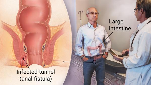 Anal Fistula